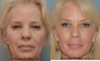 55-64 year old woman treated with Laser Resurfacing and blepharoplasty.