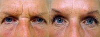55-64 year old woman treated with Brow Lift