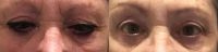 55-64 year old woman treated with Ptosis Surgery