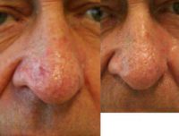 55-64 year old man treated with Rosacea Treatment using the Gemini KTP laser