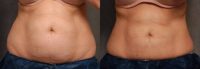 59 year old woman treated with CoolSculpting