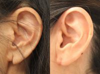 55-64 year old woman treated with Torn Earlobe Repair Surgery