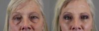 55-64 year old woman treated with Eyelid Surgery