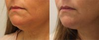 55-64 year old woman treated with Kybella