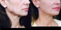 55-64 year old woman treated with Facelift fat grafting