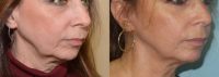 55-64 year old woman treated with Ultherapy