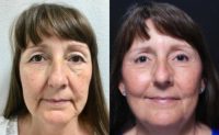 55-64 year old woman treated with Blepharoplasty