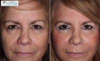 55-64 year old woman treated with Eyelid Surgery, Laser Resurfacing, Instalift and Fillers