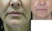 55-64 year old woman treated with Restylane