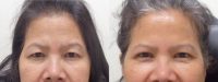 55-64 year old woman treated with Double Eyelid Surgery