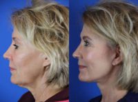 63 year old woman treated with Facelift