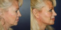 55-64 year old woman treated with Lifestyle Lift