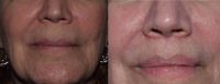 55-64 year old woman treated with Lip Lift