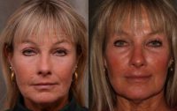 64 year old woman treated with Botox