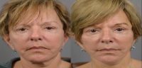 65-74 year old woman treated with EZ Lift™, Grin Lift and Fat Injections