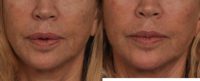 65-74 year old woman treated with Lip Reduction