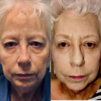 67-year old patient with Blepharoplasty and Fat Transposition