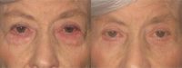 65-74 year old woman treated with Eye Bags Treatment