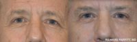 65-74 year old man with asymmetry in the upper eyelids was treated with Eyelid Surgery