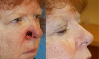 65-74 year old woman treated with Facial Reconstructive Surgery