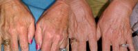 65-74 year old woman treated with SmartXide DOT fractionated CO2 laser for hand rejuvenation