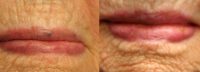 65-74 year old woman treated with Yag Laser