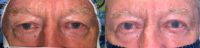 65-74 year old man treated with Eyelid Surgery