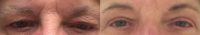 65-74 year old woman treated with Eyelid Surgery (Blepharoplasty)