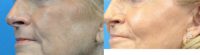 65-74 year old woman treated with Cheek Augmentation