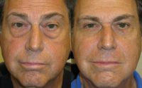 70 year old man treated with Lower Eyelid Blepharoplasty