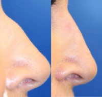 65-74 year old woman treated with Non Surgical Nose Job