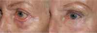 65-74 year old woman treated with Eyelid Retraction Repair