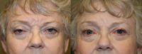 65-74 year old woman treated with Upper Eyelid Ptosis Surgery