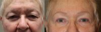 65-74 year old woman treated with upper and lower eyelid blepharoplasty