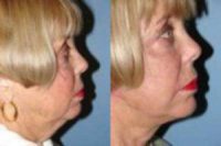 65-74 year old woman treated with Lower Face Lift