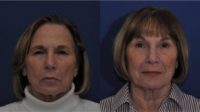 75 and up year old woman treated with Brow Lift and Upper Blepharoplasty