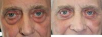 75 and up year old man treated with Eye Bags Treatment