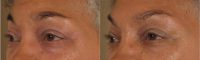 75 and up year old woman treated with Restylane