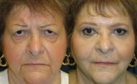 75 and up year old woman treated with Eye Bags Treatment