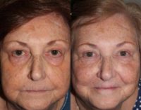 75 year old woman treated with Upper and Lower Eyelid Blepharoplasty