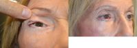 86 year old female underwent revision right canthoplasty.