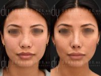 Asian Rhinoplasty with Rib cartilage and DCF