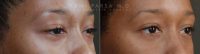 Before and After bilateral lower eyelid blepharoplasty