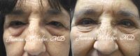 Brow Lift and Upper Blepharoplasty