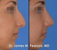 Rhinoplasty / Nose Reshaping in Middle Eastern Female