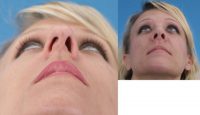 rhinoplasty (nose surgery) to repair crooked nose