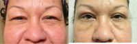 45-54 year old woman treated with Brow Lift, Ptosis Repair, and Blepharoplasty
