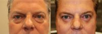 45-54 year old man treated with Eye Bags Treatment