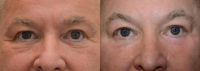 45-54 year old man treated with Chemical Peel