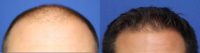 Hair loss in male on finasteride and too young for hair transplant - non-surgical treatment - front